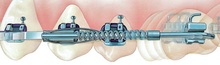 Load image into Gallery viewer, Lancer Lokar Molar Distiliser (10 Pack)
